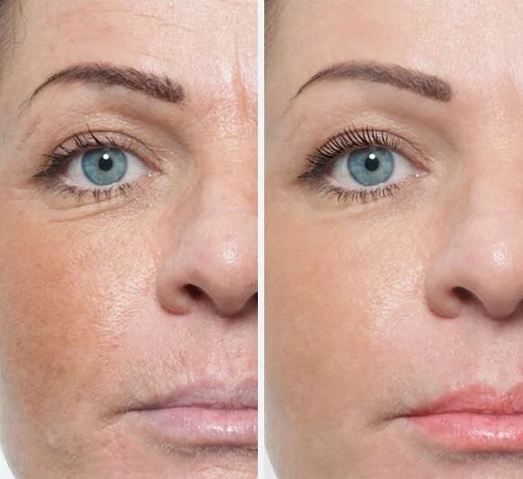 Collagen Restart Serum - Intenzív ránctalanító  Irritáció nélkül újraindítja a kollagéntermelést akár 7 nap alatt frissebb, feszesebb bőrt adjon.